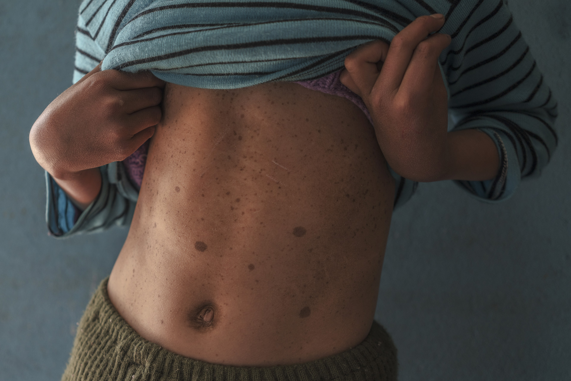 macchie sulla pelle di una bambina, conseguenza dell'inquinamento a cerro del pasco